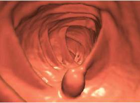 Overdiagnosis in cancer needs to be addressed Overdiagnosis in cancer needs to be addressed