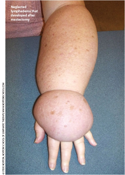 ona_0710_lymphedema_art_109956_109959.jpg