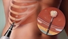 Tumor ablation treatment A review of modalities