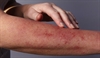 Managing asparaginaserelated toxicity in adult patients