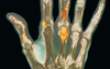 Drugrelated skeletal effects and managing vaginal dryness