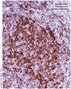 Differentiating is key to non-Hodgkin lymphomas