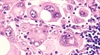 New monoclonal antibody is a source of hope for patients with metastatic melanoma