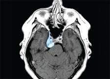 New approach improves skull-base tumor surgery New approach improves skull-base tumor surgery