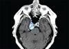 New approach improves skullbase tumor surgery
