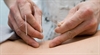 Exploring holistic medicine Using acupuncture to relieve cancerrelated fatigue
