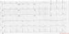 Myocardial infarction on ECG