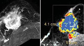 New software could speed up breast cancer diagnosis with 90% accuracy and without the need for a specialist. New software could speed up breast cancer diagnosis with 90% accuracy and without the need for a specialist.