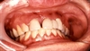 Kaposi sarcoma of the mouth