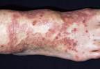 Diagnosis of radiation recall hampered by delayed occurrence Diagnosis of radiation recall hampered by delayed occurrence