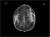 Breast Positioning during Mammography Breast Positioning during Mammography