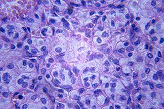 Pembrolizumab and Ipilimumab Combo Safe for Melanoma and Renal Cell ... - Oncology Nurse Advisor
