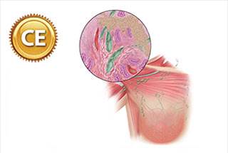 IBC diagnosis is still based on visible symptoms rather than a specific pathological test. IBC diagnosis is still based on visible symptoms rather than a specific pathological test.