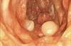 MSTF Releases Updated Recommendations for Colorectal Cancer Screening MSTF Releases Updated Recommendations for Colorectal Cancer Screening