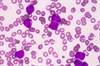 Midostaurin Improves Survival in Acute Myeloid Leukemia With FLT3 Mutation Midostaurin Improves Survival in Acute Myeloid Leukemia With FLT3 Mutation