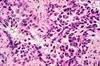 Adjuvant Durvalumab Therapy May Prolong Progression-free Survival in NSCLC Adjuvant Durvalumab Therapy May Prolong Progression-free Survival in NSCLC