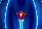 Intentional Weight Loss Associated With Endometrial Cancer Risk Intentional Weight Loss Associated With Endometrial Cancer Risk
