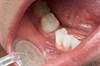 Risk of Some Cancers Higher in Women With a History of Periodontal Disease Risk of Some Cancers Higher in Women With a History of Periodontal Disease