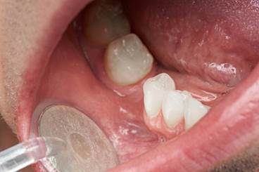 Risk of Some Cancers Higher in Women With a History of Periodontal Disease Risk of Some Cancers Higher in Women With a History of Periodontal Disease