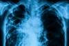 Early Recognition of Checkpoint Inhibitor-Related Pneumonitis Improves Outcomes Early Recognition of Checkpoint Inhibitor-Related Pneumonitis Improves Outcomes