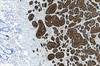 FDA Approves Supplemental Indication for Lanreotide Depot for Carcinoid Syndrome FDA Approves Supplemental Indication for Lanreotide Depot for Carcinoid Syndrome