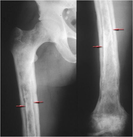 Остеомиелит Кости Фото — Картинки фотографии