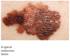 Melanoma associated with indoor tanning Melanoma associated with indoor tanning