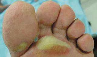 Prevention and management of hand-foot syndromes Prevention and management of hand-foot syndromes