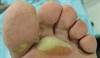 Prevention and management of hand-foot syndromes Prevention and management of hand-foot syndromes
