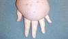 Lymphedema: Diagnosis, prevention, and management Lymphedema: Diagnosis, prevention, and management