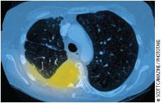 Non-small cell lung cancer therapy has mixed results Non-small cell lung cancer therapy has mixed results
