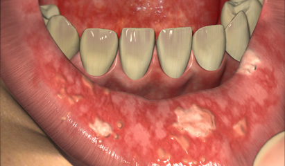 Oral care considerations during the patient's cancer treatment - ONA