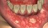 Oral care considerations during the patient's cancer treatment Oral care considerations during the patient's cancer treatment