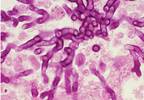 Nurses' concern for infections grows Nurses' concern for infections grows