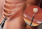 Tumor ablation treatment: A review of modalities Tumor ablation treatment: A review of modalities