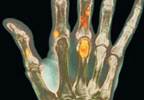 Proper use of denosumab for skeletal conditions Proper use of denosumab for skeletal conditions