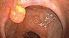 Lynch syndrome: Identifying patients at risk for HNPCC Lynch syndrome: Identifying patients at risk for HNPCC