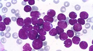 Total XV protocol significantly improves survival in older adolescents with leukemia Total XV protocol significantly improves survival in older adolescents with leukemia