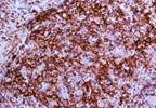 Differentiating type is key to non-Hodgkin lymphomas Differentiating type is key to non-Hodgkin lymphomas