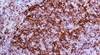 Differentiating type is key to non-Hodgkin lymphomas Differentiating type is key to non-Hodgkin lymphomas