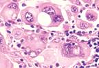 New monoclonal antibody is a "source of hope" for patients with metastatic melanoma New monoclonal antibody is a "source of hope" for patients with metastatic melanoma