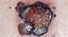 New treatments are improving outcomes in melanoma New treatments are improving outcomes in melanoma