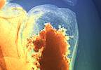 Guidelines reflect changes in radiotherapy for bone metastases Guidelines reflect changes in radiotherapy for bone metastases