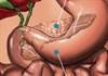 How would I know if I may have pancreatic cancer? How would I know if I may have pancreatic cancer?