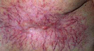 Reexcision rates after partial mastectomy vary greatly Reexcision rates after partial mastectomy vary greatly