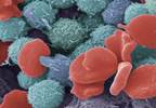 Leukemia: Understanding its types and treatments Leukemia: Understanding its types and treatments