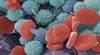 Leukemia: Understanding its types and treatments Leukemia: Understanding its types and treatments