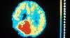 PET/CT changes brain tumor treatment plans PET/CT changes brain tumor treatment plans