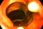 Virtual colonoscopy is an accurate screen in seniors Virtual colonoscopy is an accurate screen in seniors