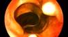 Virtual colonoscopy is an accurate screen in seniors Virtual colonoscopy is an accurate screen in seniors